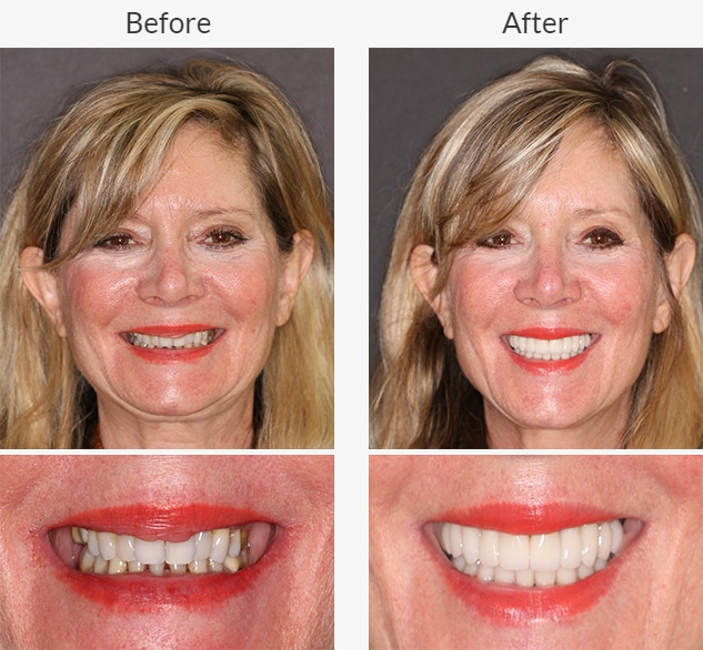 close up and portrait photos before and after dental treatment