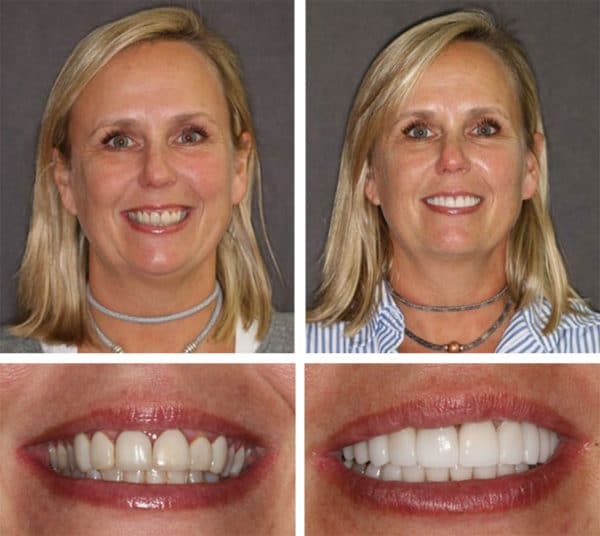 before and after results of dental crowns, patient of Beyond Exceptional Dentistry 