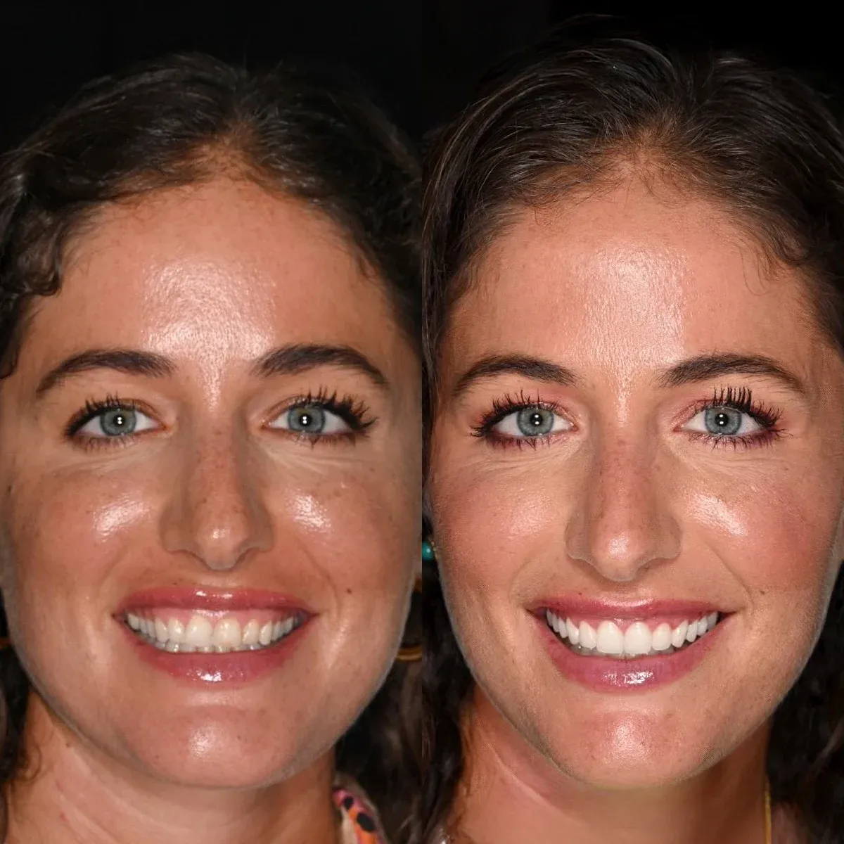 before-after-beyond-exceptional-dentistry