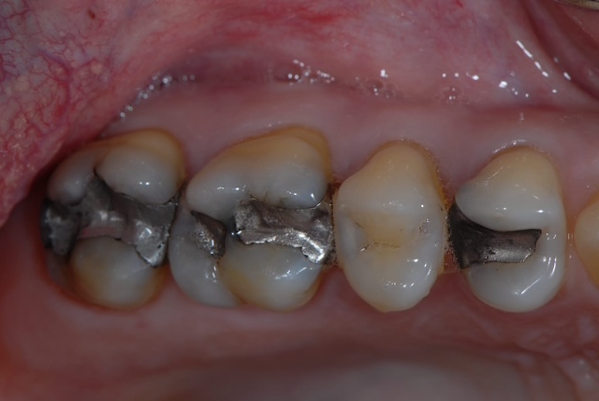 T.ThurstonULAmalgam