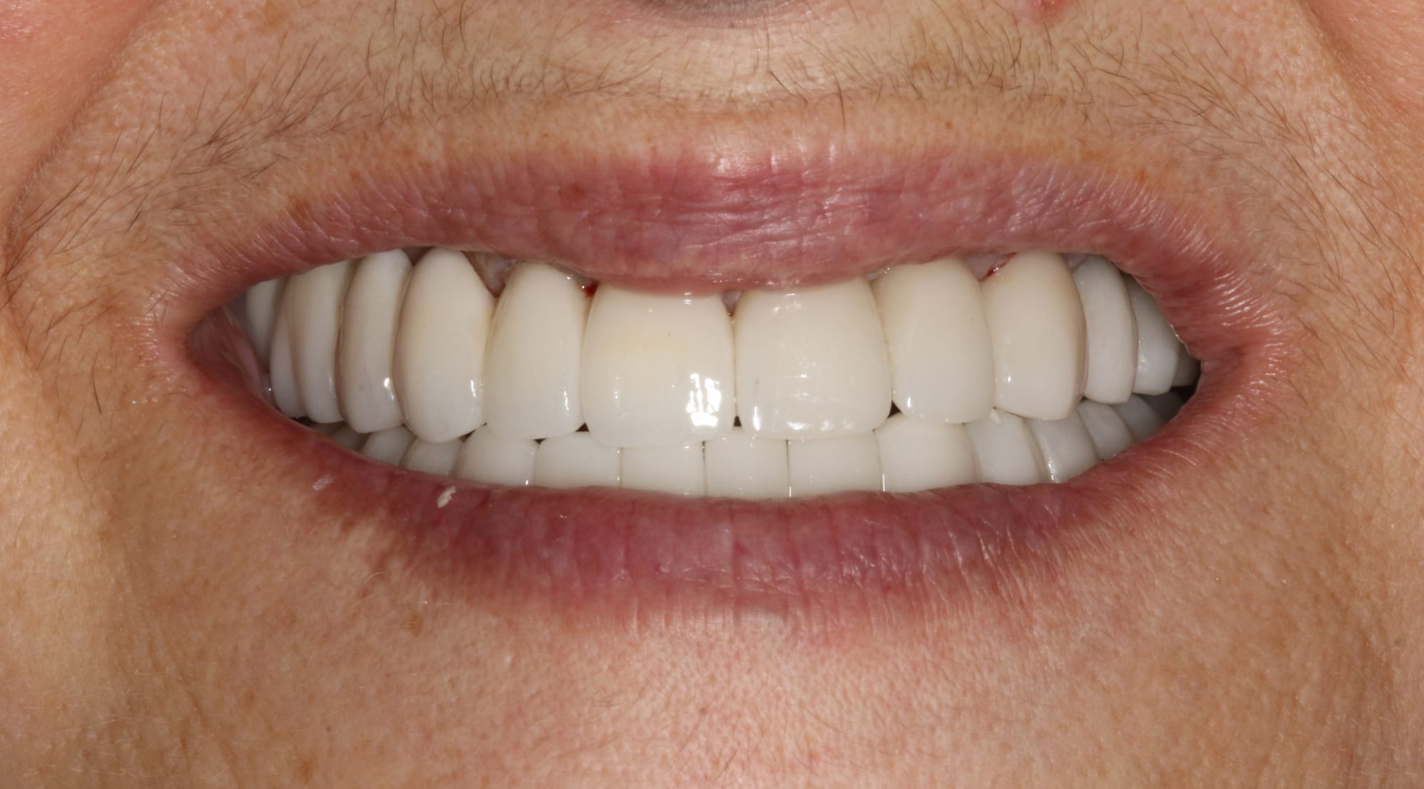 after smile-1